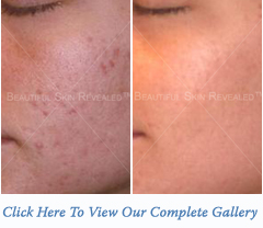acne1-bna-thumb