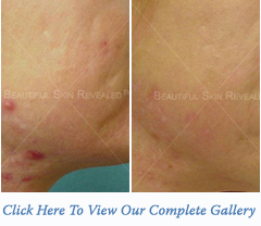 acne2-thumb