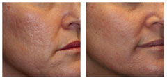 Acne Scar Removal Houston Texas (TX) New York (NY)