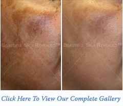 melasma melasma