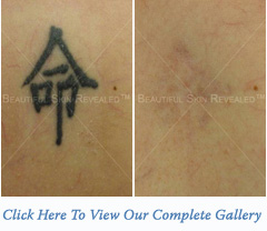 Tattoo Removal Houston
