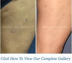 acne1-bna-thumb