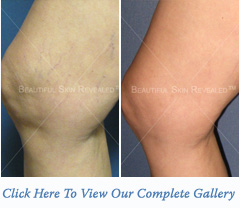 acne2-thumb acne2-thumb