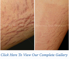 Stretch Marks Treatment Houston Texas (TX) New York (NY)