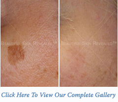 Age Spots Treatment Houston Texas (TX) New York (NY)