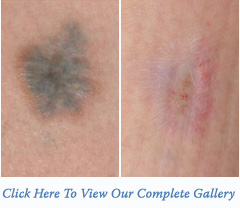 Laser Tattoo Removal Houston Texas (TX) New York (NY)