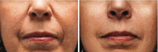 wrinkle reduction