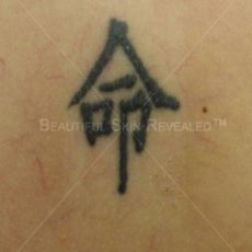 Tattoo Removal Results