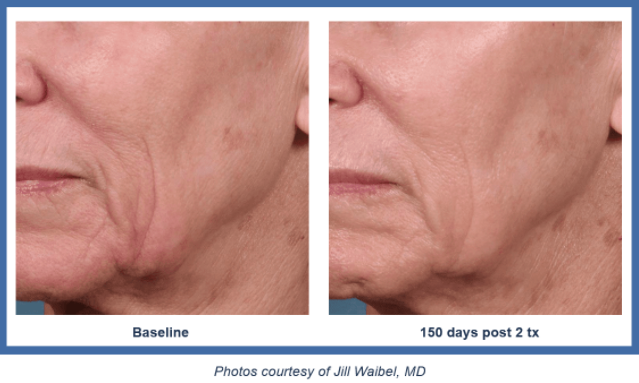 Ellacor by Cytrellis Skin Tightening Houston TX