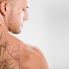 Man shwoing the slow progression of a tattoo removal