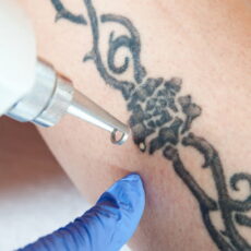 Tattoo Removal on a sex trafficking victim