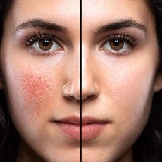 picture of woman with half her face with rosacea before treatment and half after