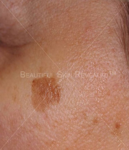 Sunspots, age spots and liver spots: What are they? - Burn and